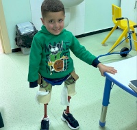 Two Amputee Children Receive Rehabilitation And Prosthesis Treatment