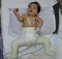 Palestinian Child Sponsored for Surgery in Jordan