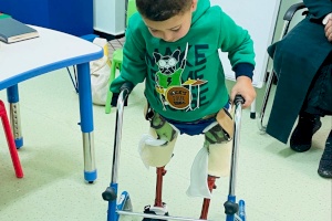 Two Amputee Children Receive Rehabilitation And Prosthesis Treatment