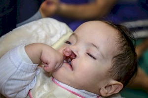 German Maxillofacial Surgery Team Operates in Gaza