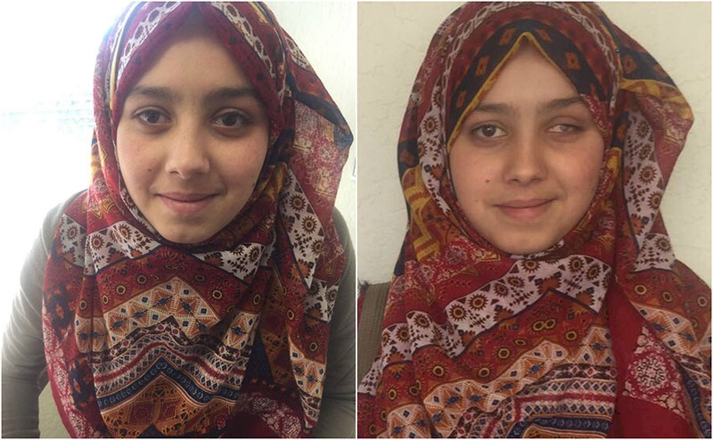 Palestinian Girl Receives Artificial Eye In the Bay Area