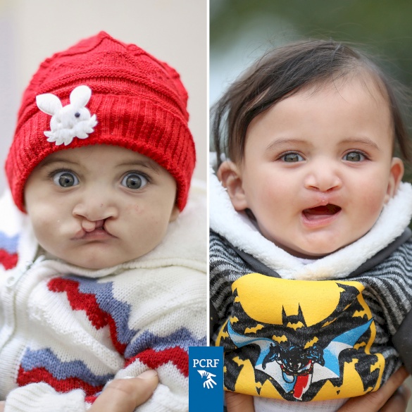 Cleft Child Recovering From Surgery in Gaza
